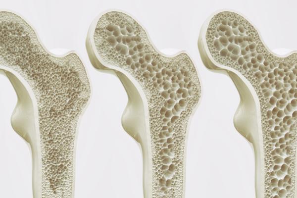 Absolutely! Here’s A Comprehensive Article About Osteoporosis, Covering Its Causes, Symptoms, Prevention, And More.