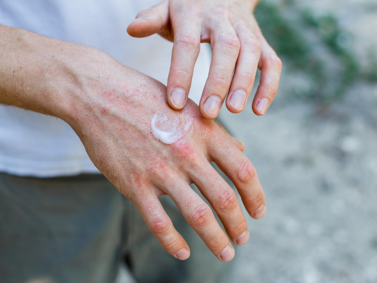 Best Home Remedies for Psoriasis Flare-Ups - BuzzyUSA