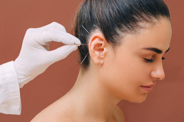 Acupuncture-For-Tinnitus